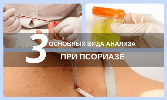 анализы при псориазе