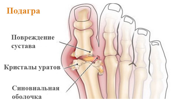 Подагрический артрит — причины
