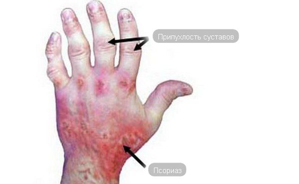 опухли суставы на пальцах