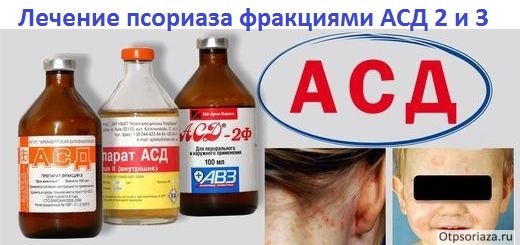 Асд при псориазе схема приема