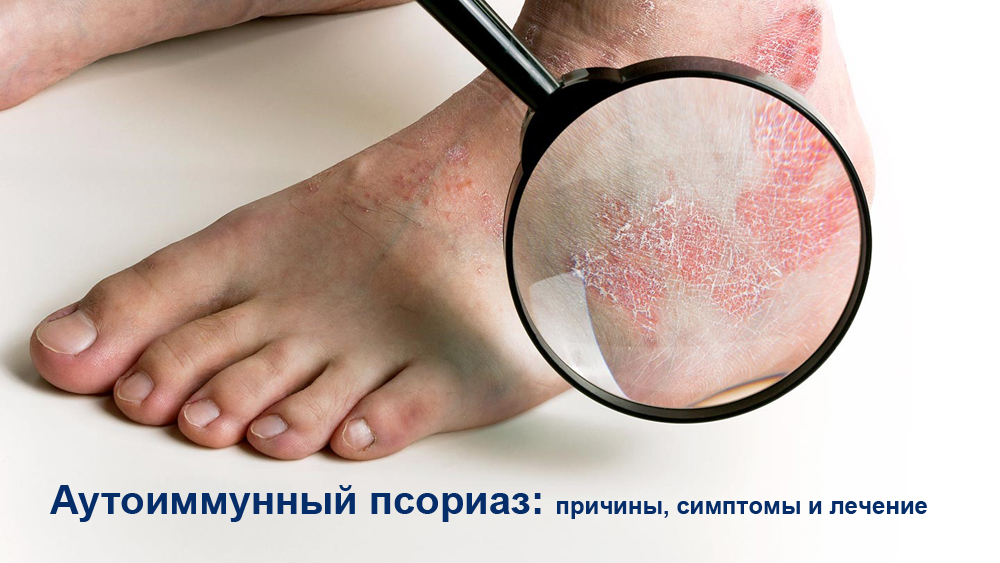 Аутоиммунный псориаз