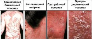 Псориаз: причины, клинические признаки, лечение и профилактика заболевания.