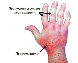 Псориатический артрит: симптомы, лечение, фото, диагностика