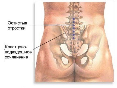 Сакроилеит: что это такое, симптомы, лечение, прогноз, препараты