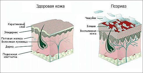 Псориаз: причины, клинические признаки, лечение и профилактика заболевания.
