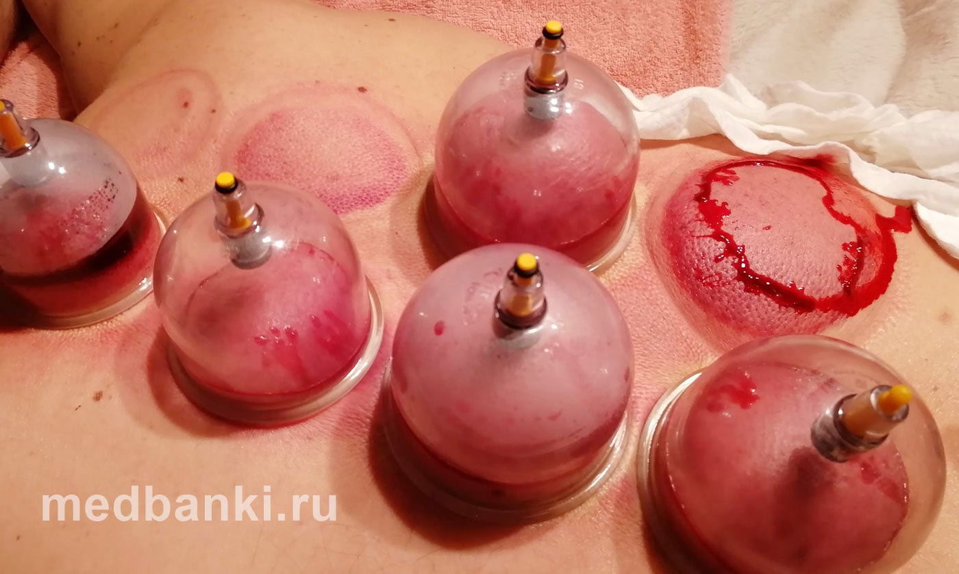 Использование банок для хиджамы