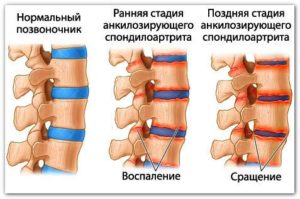 Что такое анкилозирующий спондилоартрит: симптомы и лечение болезни Бехтерева поясничного отдела позвоночника