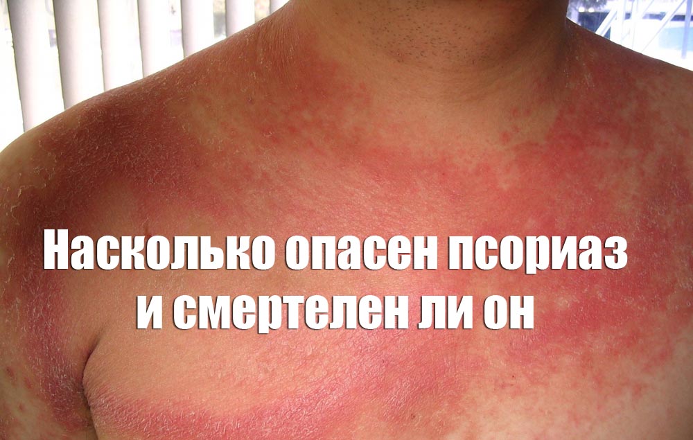 Насколько опасен псориаз и смертелен ли он