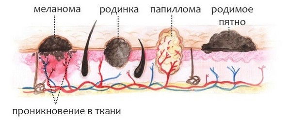 чем отличается бородавка от папилломы