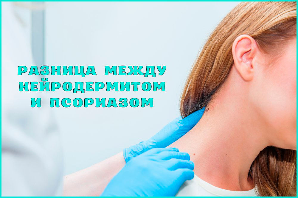 Чем отличается нейродермит от псориаза