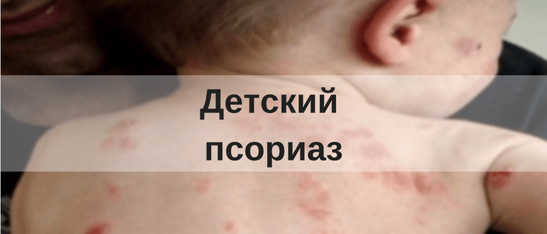 Псориаз у ребенка 5 лет