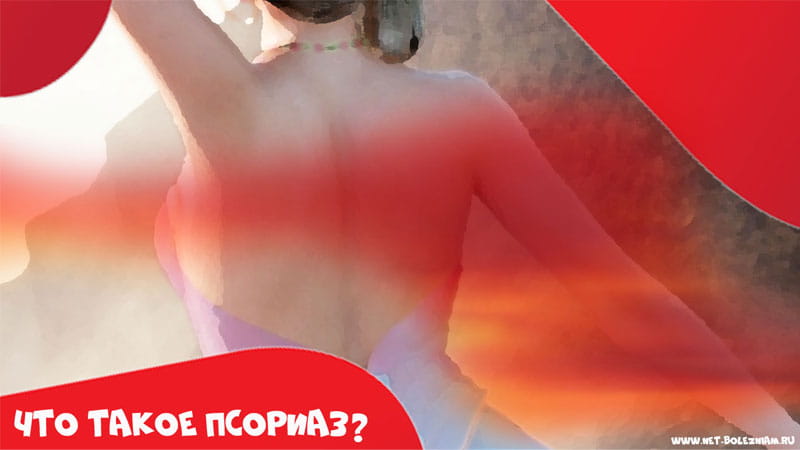 Что такое псориаз?