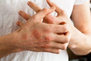 Кожный зуд при псориазе: средства и лечение