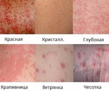 Сильная потница: её виды и их сравнение