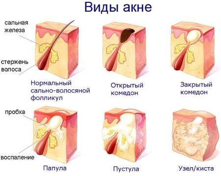 Настойка гриба Веселка. Применение, инструкция, от каких болезней, польза, вред, как приготовить