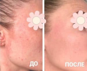 Атоптический дерматит лица