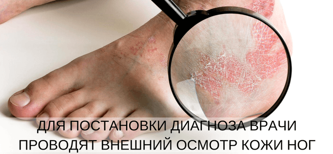 диагностика псориаза на ногах