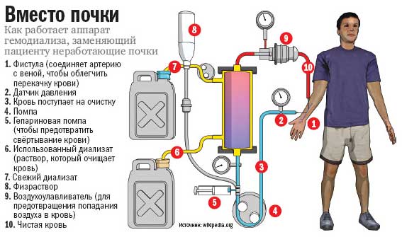 диализ