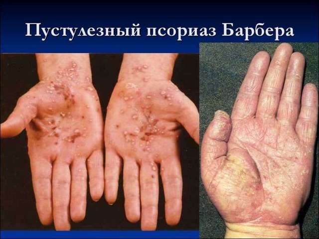 Генерализованный пустулезный псориаз Цумбуша: причины, симптомы, лечение