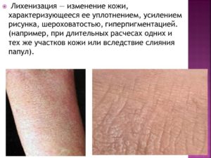 Распространенный атопический дерматит с очаговой лихенификацией