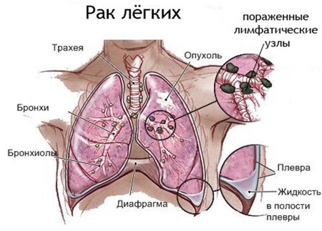 Сколько живут с водой в легких – прогноз