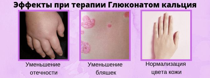 Эффекты при терапии Глюконатом кальция