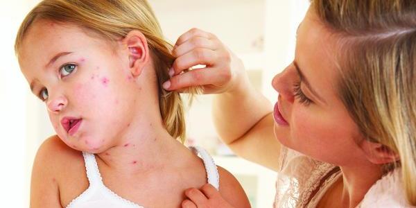 Передается ли псориаз от родителей детям и с какой вероятностью?