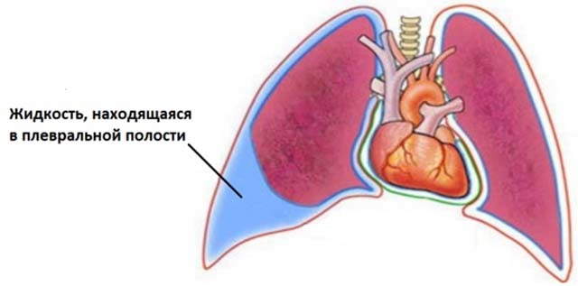 Сколько живут с водой в легких – прогноз
