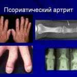 Диабет и псориаз: симптомы, причины, лечение, профилактика