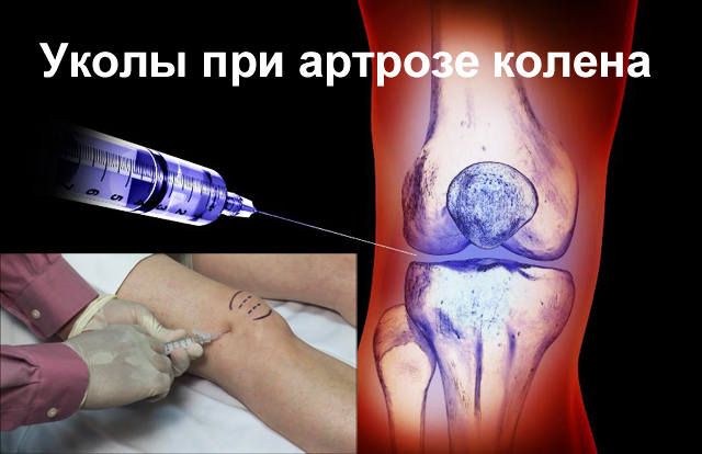 Уколы при артрите в сустав и внутримышечно - лечение инъекциями