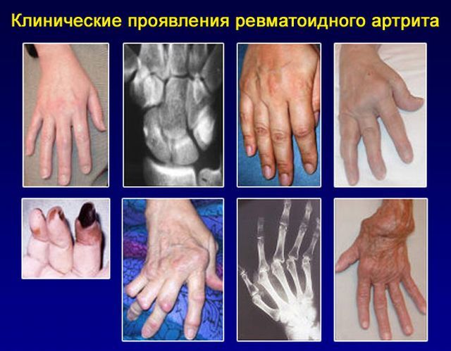 Инвалидность при артрите ревматоидного и псориатического вида
