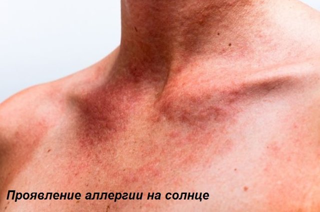 Почему появляются красные зудящие пятна на теле?