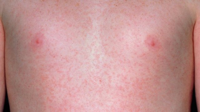 Красные пятна на коже – причины, фото и как избавиться