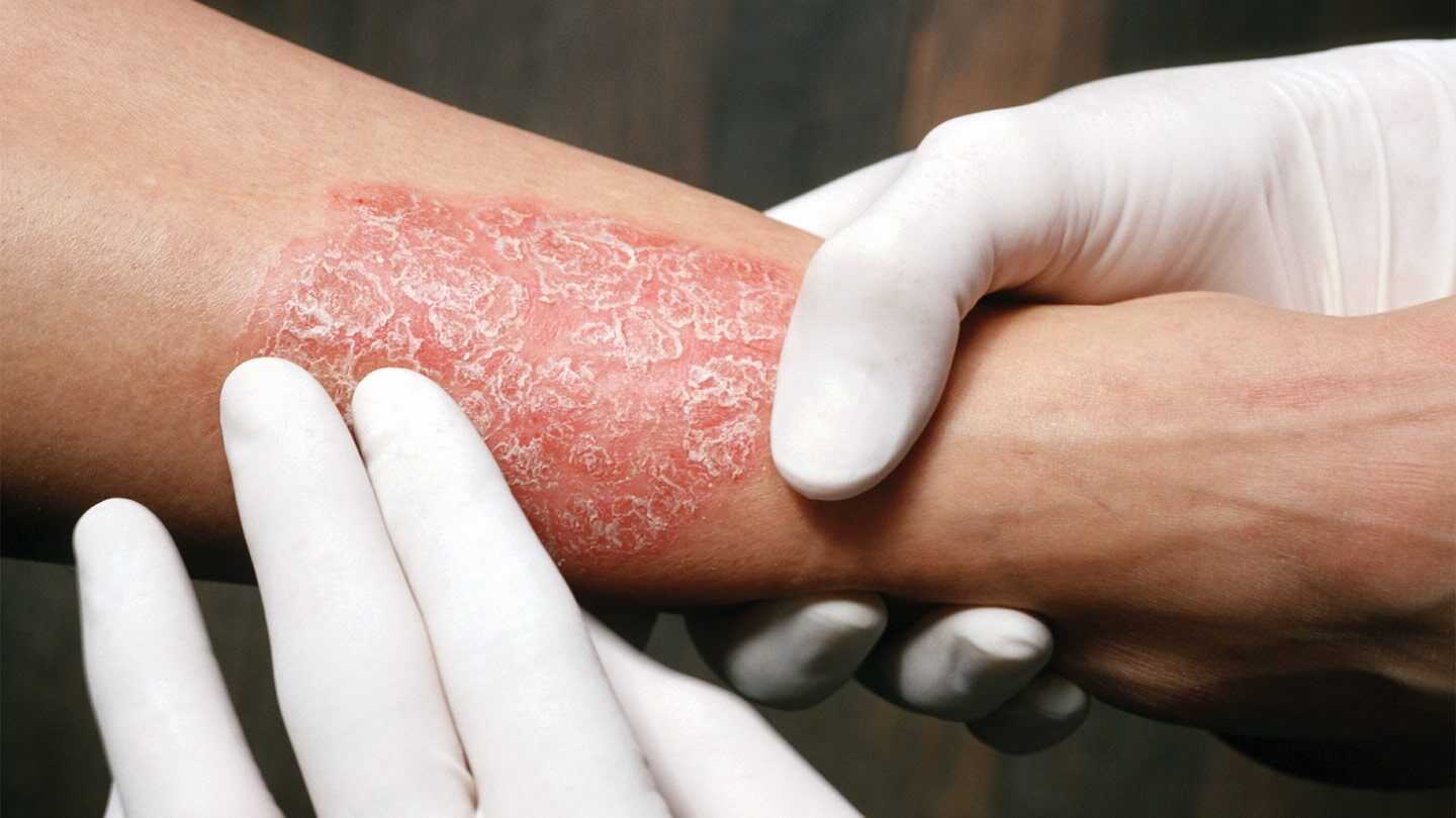 lechenie-psoriaza