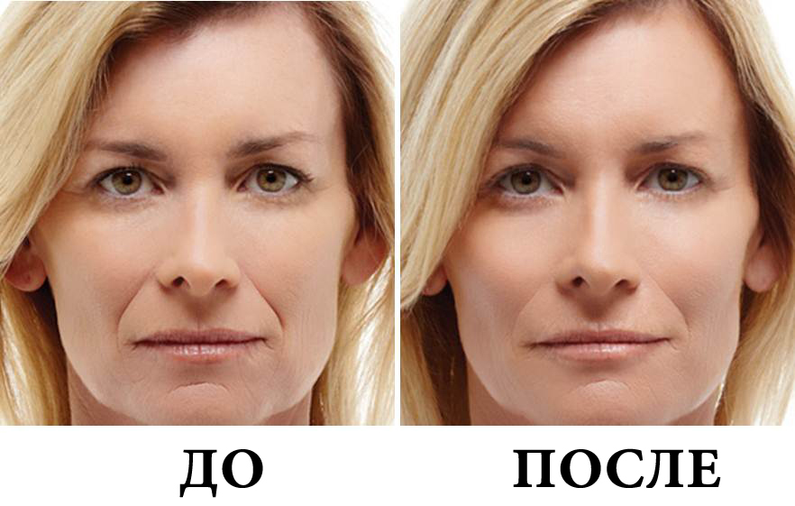 Гиалуроновая кислота