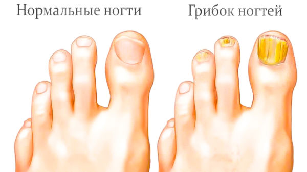 Нормальные ногти и грибок