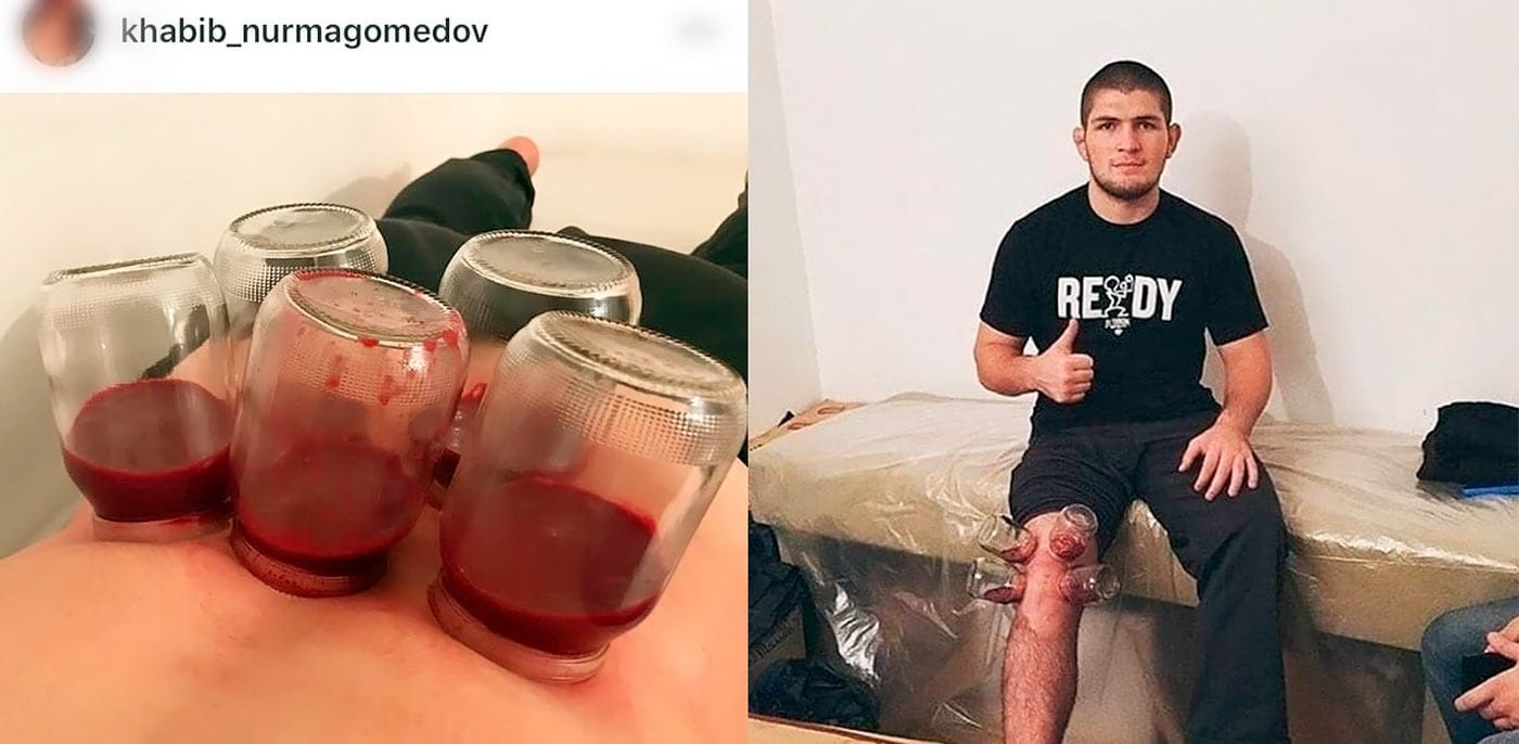 Хабиб Нурмагомедов использует хиджаму