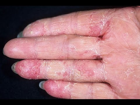Экзема на руках - более 10 лет мучений /сыроедение/история моей ...
