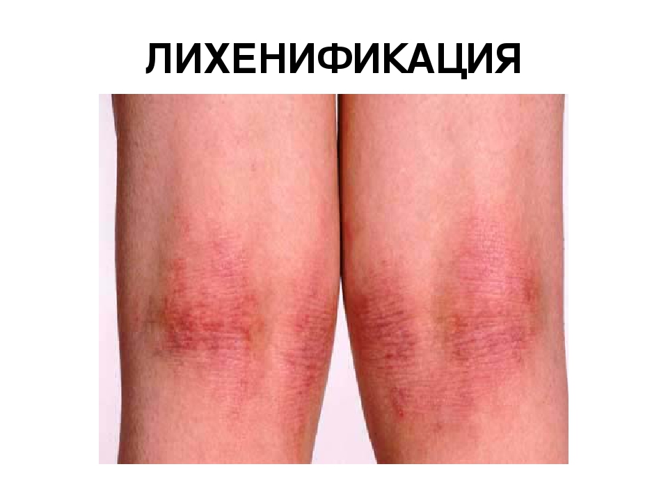 Лихенификация