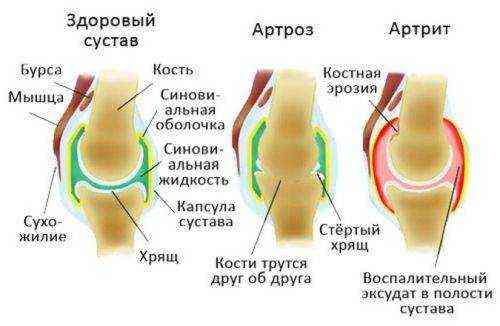 какой врач лечит артрит артроз
