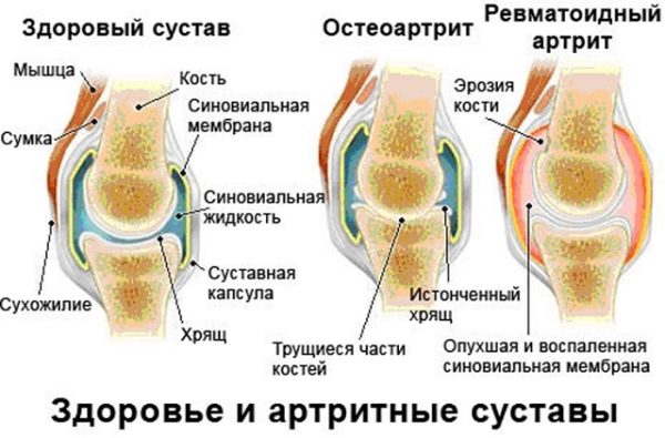 как долго можно принимать метотрексат при ревматоидном артрите