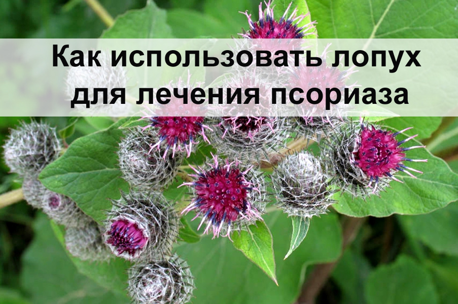 Как использовать лопух для лечения псориаза