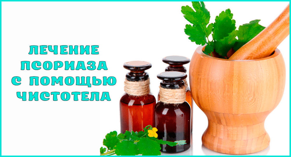Как лечить псориаз чистотелом