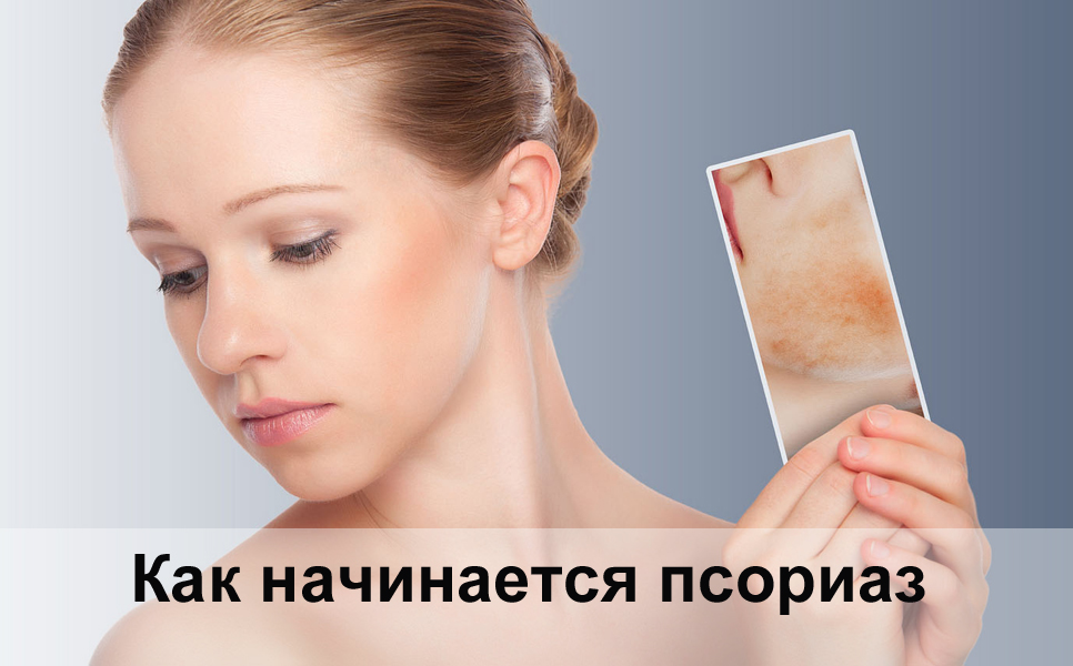 Как начинается псориаз