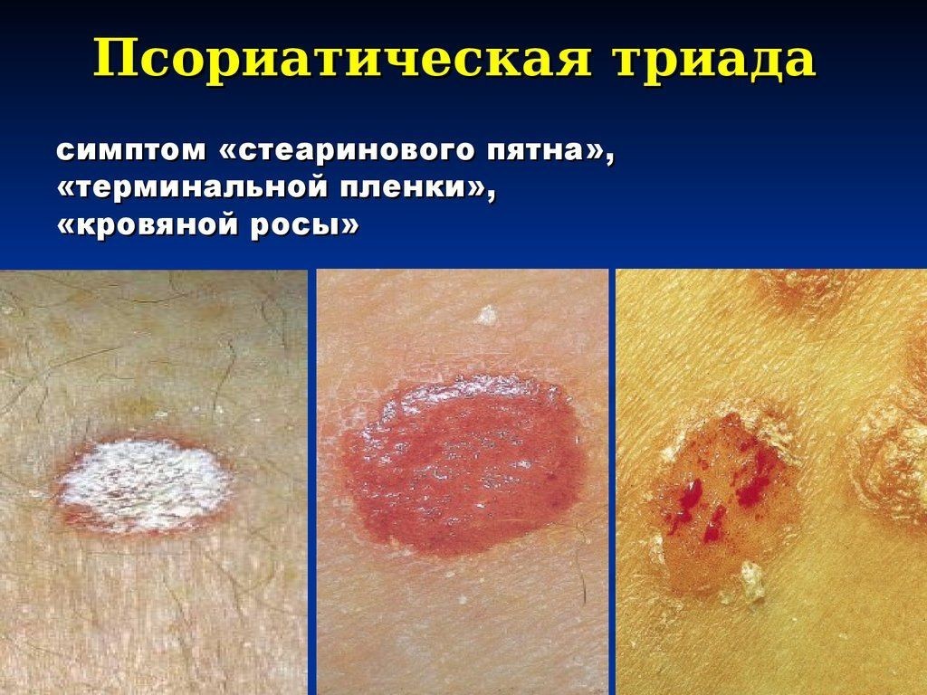 Как отличить псориаз от себорейного дерматита