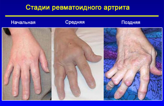 Основные симптомы ревматического полиартрита тесты