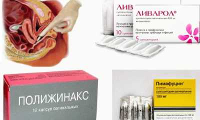 Лечение кандидоза у женщин
