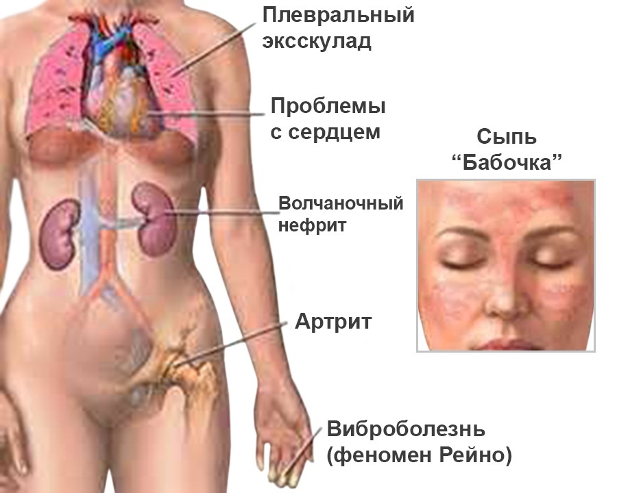 красная волчанка: симптомы, причины, фото у женщин и картинки