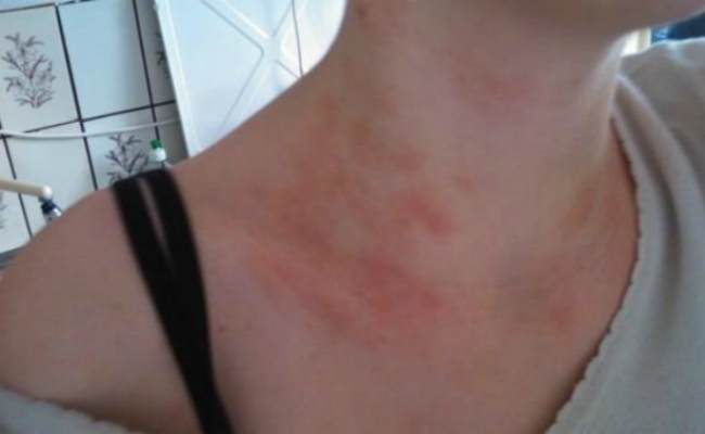 красные пятна на шее от нервов-причины и что делать
