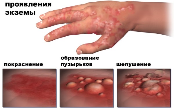 Крем Зорька. Инструкция по применению для людей от трещин на пятках, при варикозе, псориазе, пяточной шпоре, дерматите, экземе, геморрое